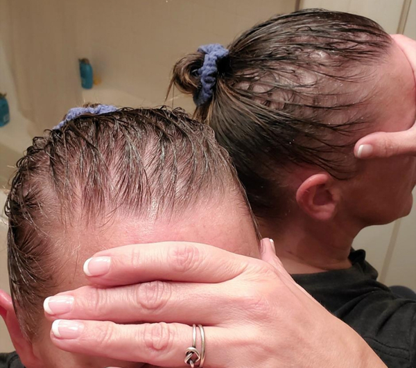 Covid Hair Loss