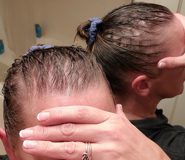 Hair Loss From Covid
