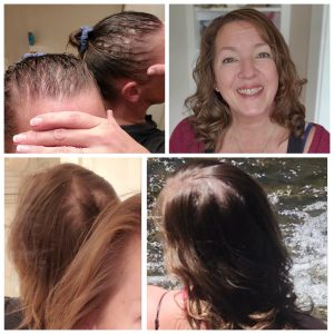 Hair Regrowth Photos