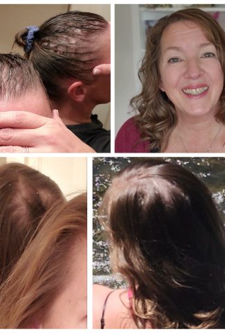 Hair Regrowth Photos