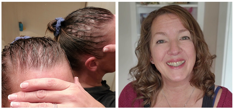 Hair Regrowth Photos